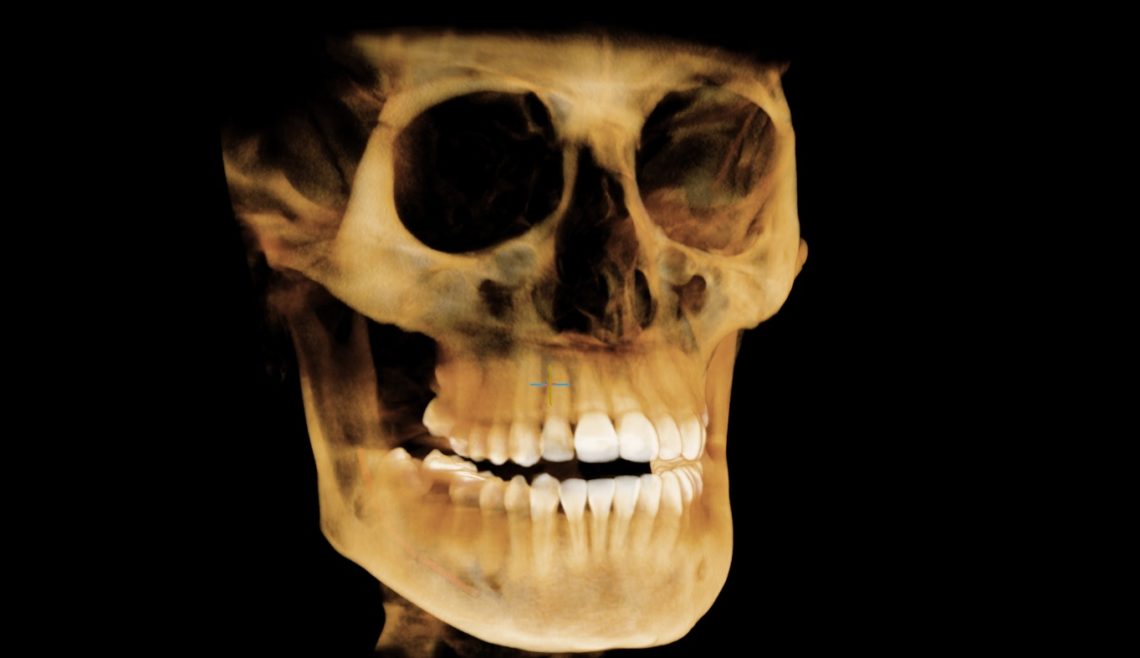 cone beam imaging hinsdale orhodontist clarendon hills orthodontist