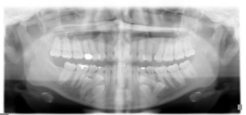 invisible adult ceramic braces adult invisalign clarendon hills hinsdale westmont western springs oak brook la grange willowbrook downers grove