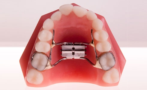 palatal expander