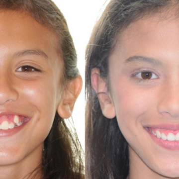 Invisalign before-and-after photos.