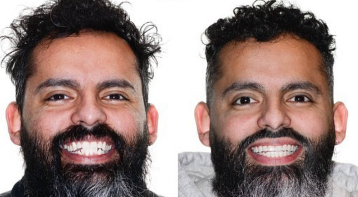 Invisalign patient in Clarendon Hills, IL