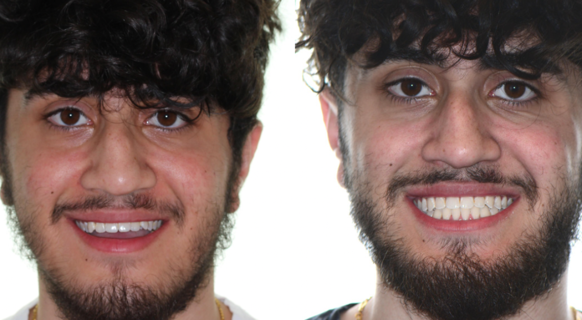 Bite correction using Invisalign.